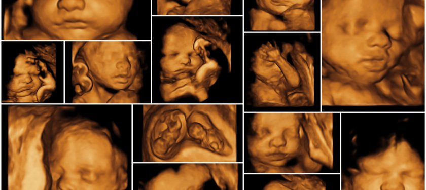 Ultrason ve Hamilelik Sürecindeki Rolü