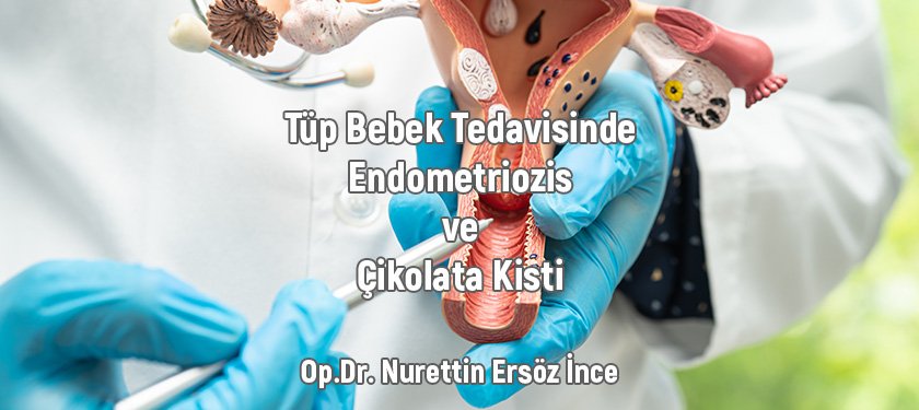 Tüp Bebek Tedavisinde Endometriozis ve Çikolata Kisti: Zorluklar ve Çözümler